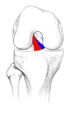 Drawing of the ACL showing the 2 bundles